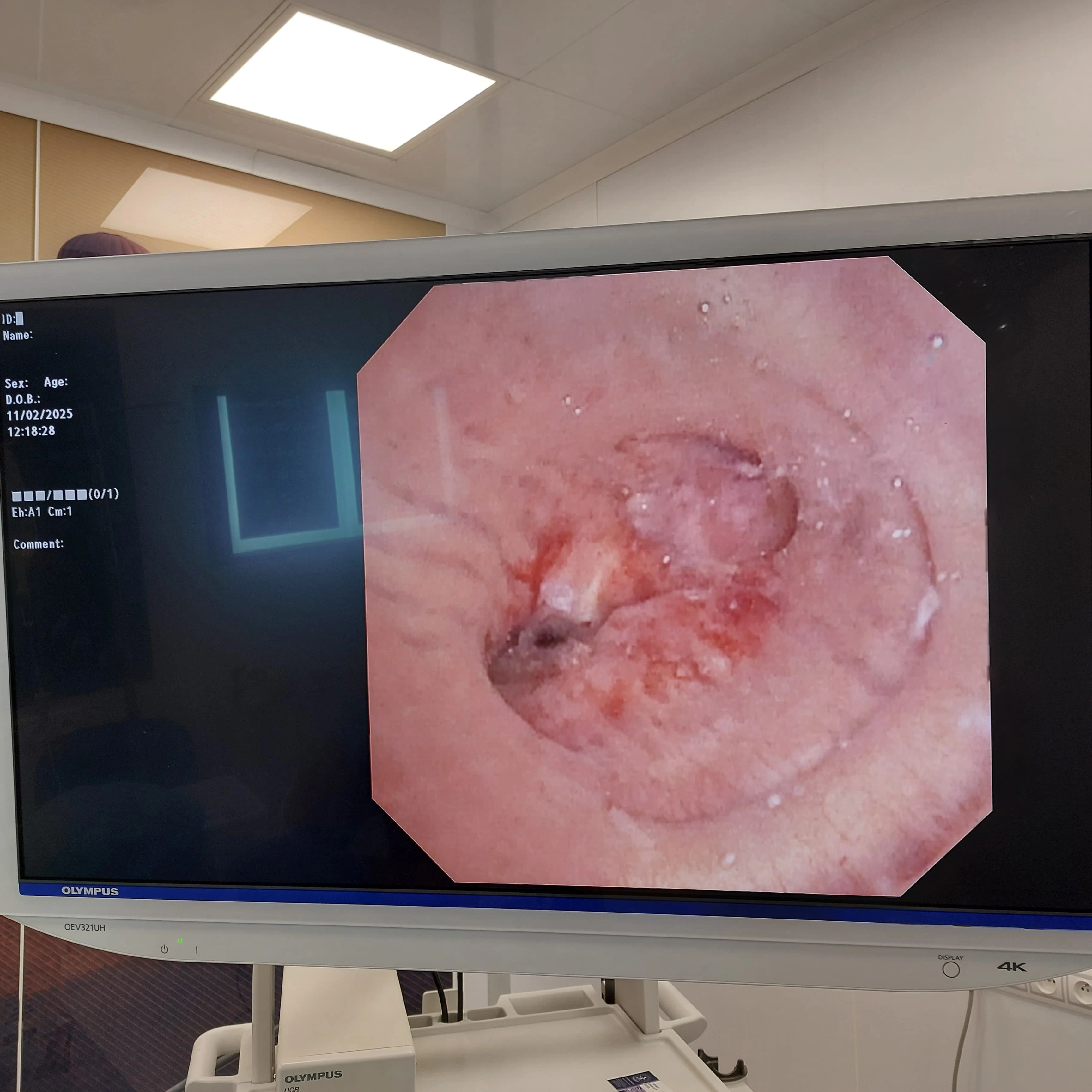 cabinet du dr Sara Kechnaoui - Néoplasie broncho-pulmonaire à Béni Mellal