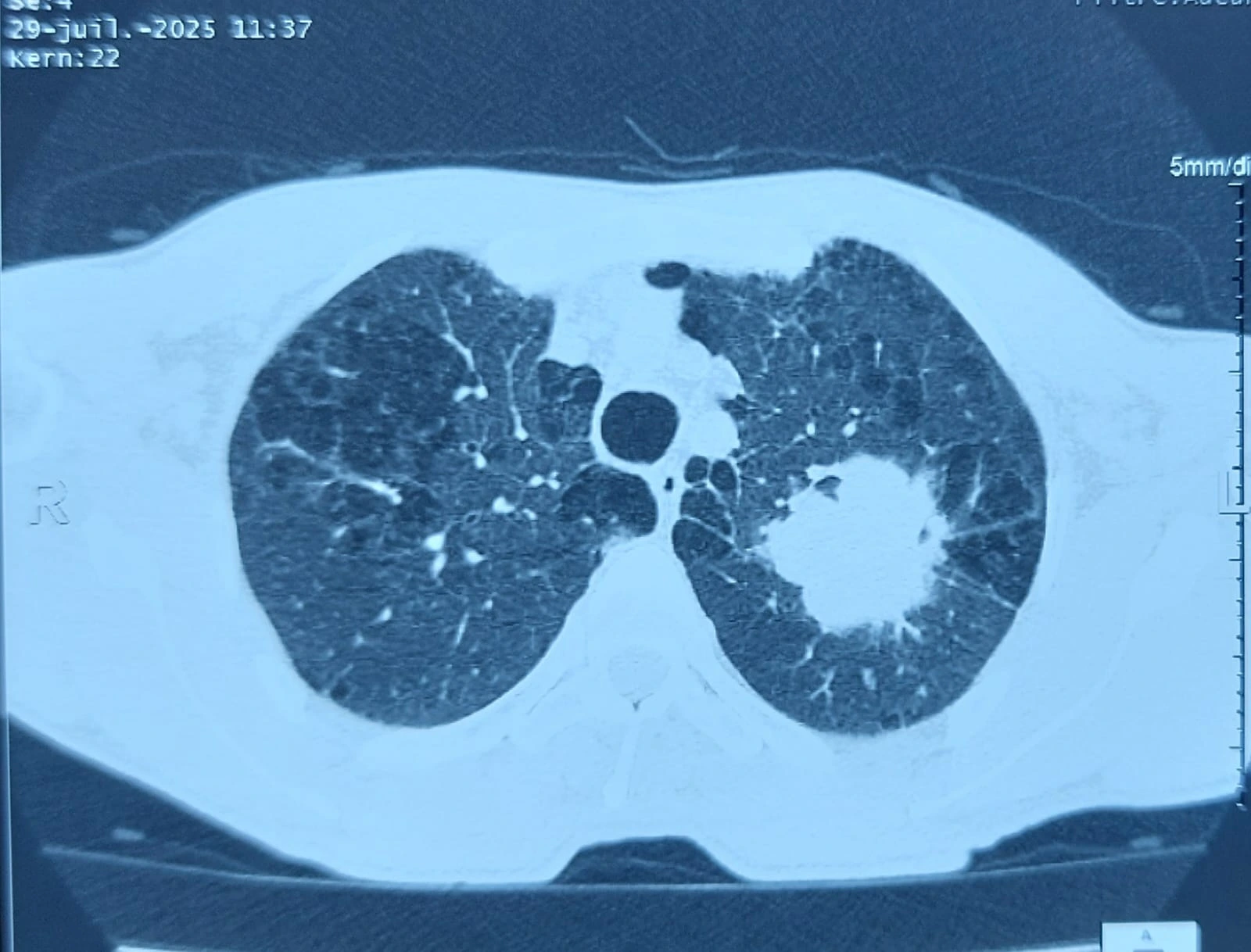cabinet du dr Sara Kechnaoui - Néoplasie broncho-pulmonaire scanaire à Béni Mellal